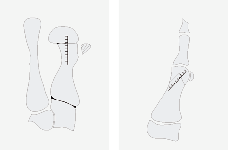 Adrian K. Wiethoff - Hallux valgus Hallux valgus