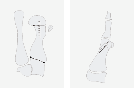 Hallux valgus