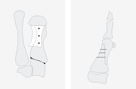 Adrian K. Wiethoff - Hallux valgus Hallux valgus