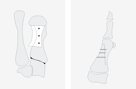 Hallux valgus